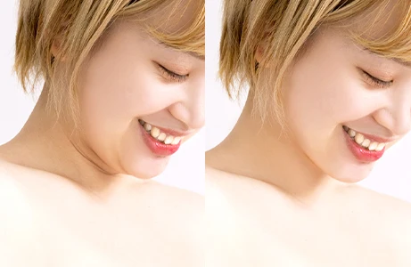 フェイスライン・二重顎